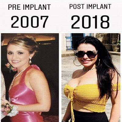 Breast Implants in Gujranwala, Peshawar & Islamabad