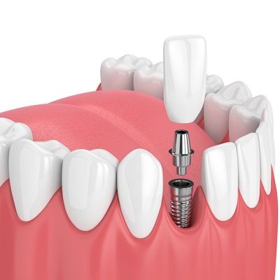 Dental implants in Islamabad, Rawalpindi & Pakistan