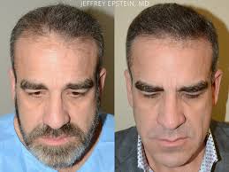 Hair Transplant in Rawalpindi Before and After