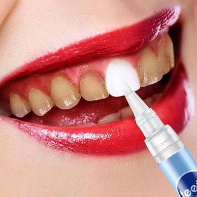 Teeth Whitening Treatment in Islamabad, Rawalpindi & Pakistan