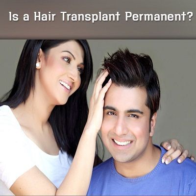 Hair Transplant Permanent in Male Pattern Baldness