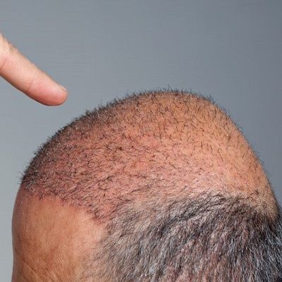 Is There any Side Effect of Hair Transplant Surgery