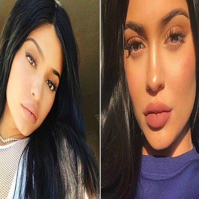 Sculptra Fillers in Islamabad