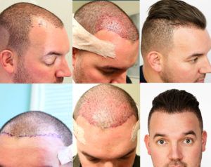 Things Done After a Hair Transplant Procedure Pakistan