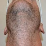 Why People Choose the Body Hair Transplantation