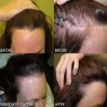 Wondering What Hair Restoration Techniques are Right for you