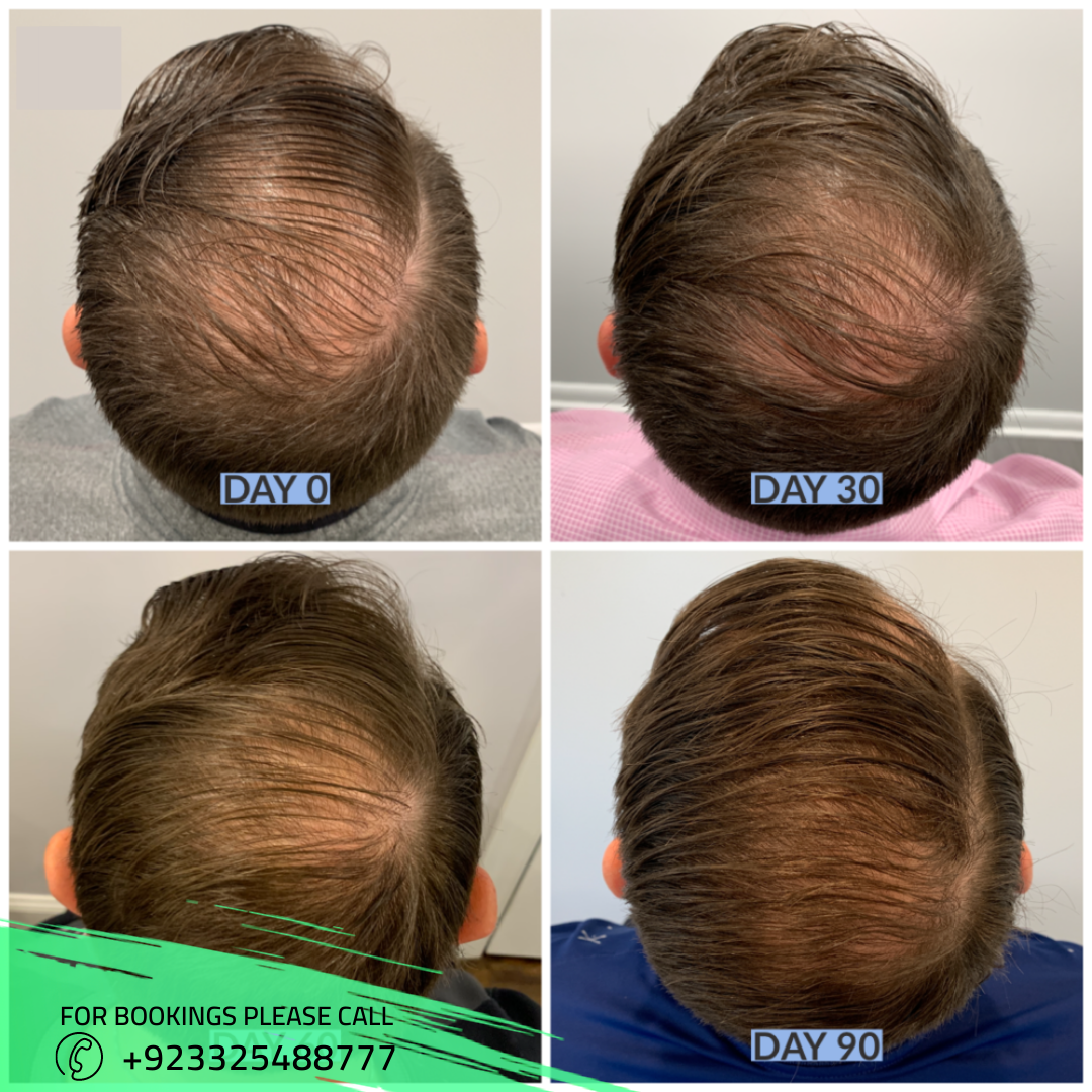 PRP hair treatment in Islamabad
