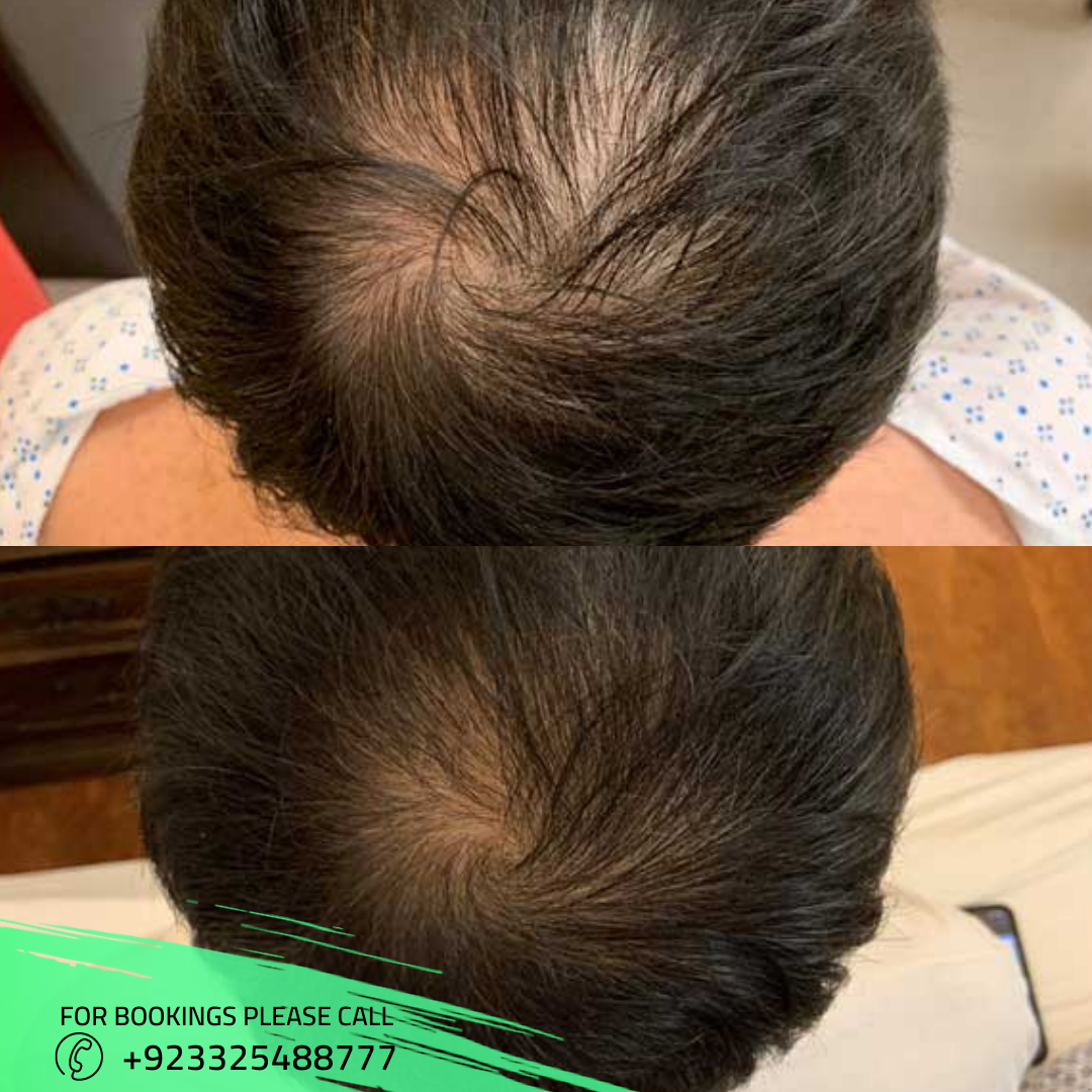 before after images of PRP hair in Islamabad