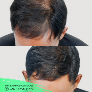 PRP hair loss treatment images 