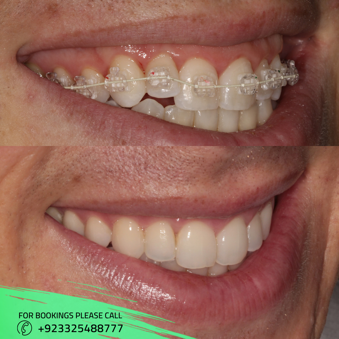 Dental Braces in Islamabad Pakistan Teeth Braces Cost