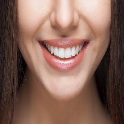 Dental veneers in Islamabad