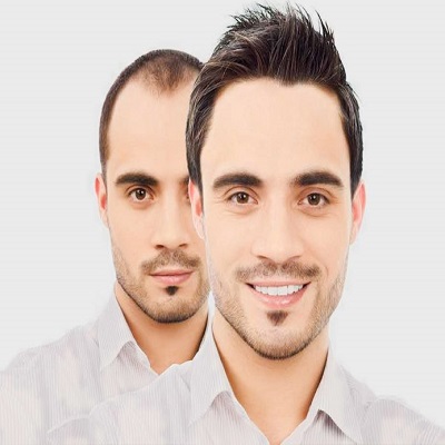 cost of hair transplant in Islamabad