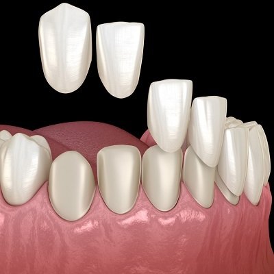  Composite Veneers in Islamabad