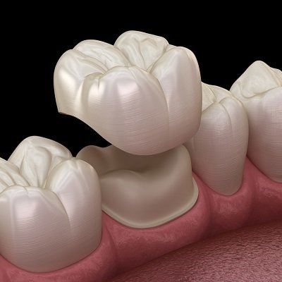 Dental Crowns in Islamabad
