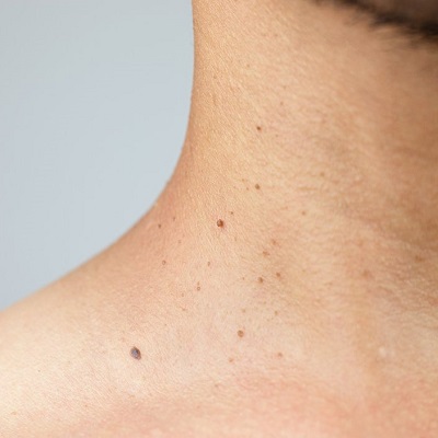 Skin Tag Removal Treatment in Islamabad (2)