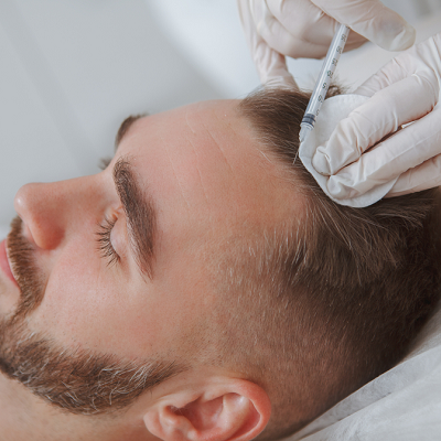 Microneedling With PRP For Hair Loss