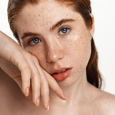 Freckles and Blemishes in Islamabad, Rawalpindi & Pakistan