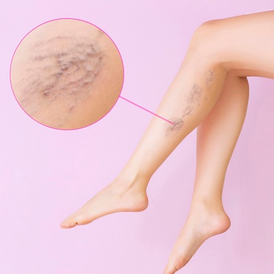 Varicose Veins Treatment in Islamabad, Rawalpindi & Pakistan