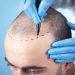 How much does a hair transplant cost in Islamabad?