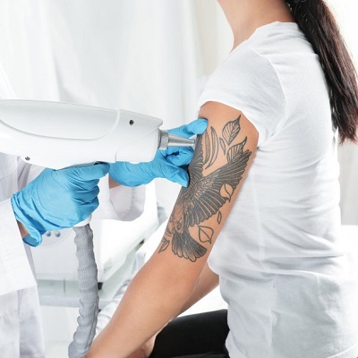 How much does laser tattoo removal cost in Pakistan?