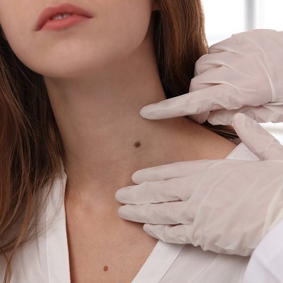 How much does skin tag removal cost in Pakistan?