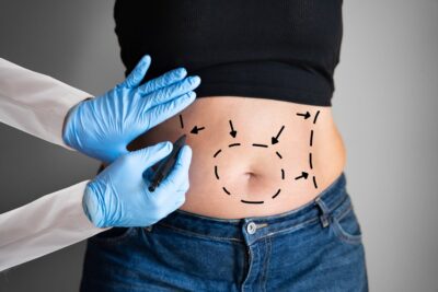 Will My Life Be Changed After Liposuction Treatment?