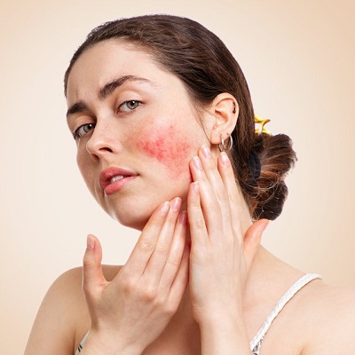 Is There Any Permanent Cure for Rosacea?