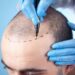 Find the Best Hair Transplant Clinics Near You: Expert Ratings and Reviews