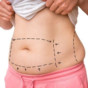 How Long Does a Tummy Tuck Last?