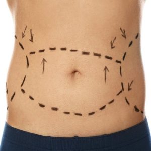 Tummy tuck cost in Islamabad