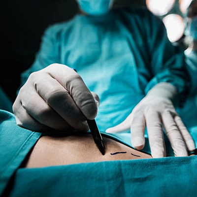 Best Surgeon For Liposuction in Islamabad