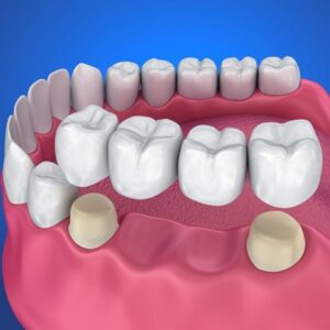 How Long Does a Crown Bridge Last?