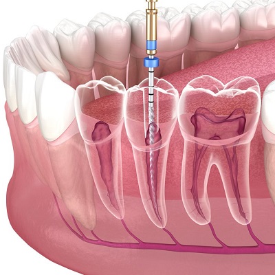 Which Filling is Best for RCT?