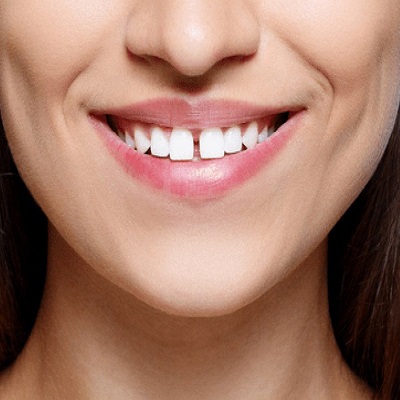Teeth Gap Filling