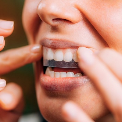 Do Dentists Recommend Teeth Whitening Strips?