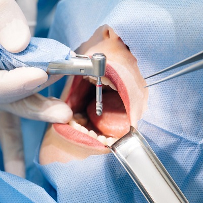 Frequent Asked Questions about Dental Implants