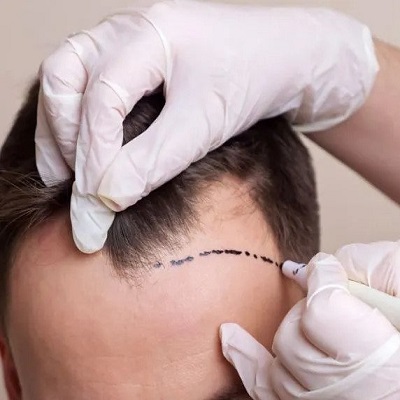 Best Hair Transplant Surgeon in Islamabad