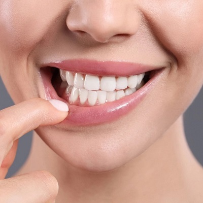 Gum Depigmentation