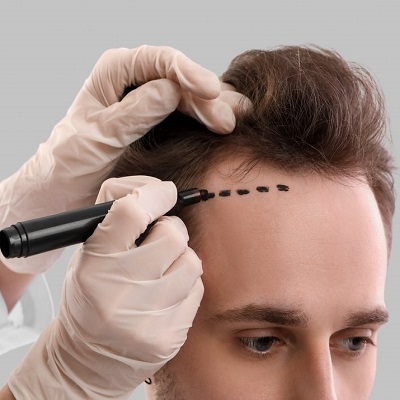How To Wash Your Hair After Hair Transplantation Procedure?