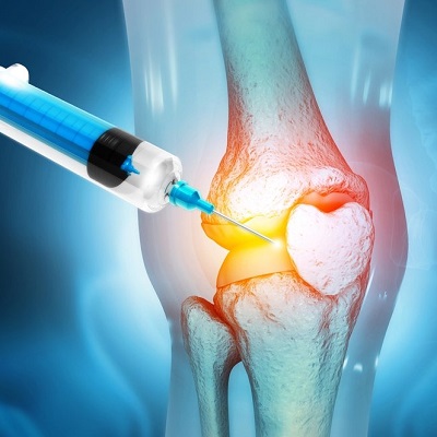 PRP for Knees