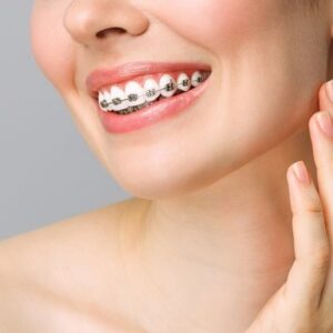 What Are the Benefits of Dental Braces?