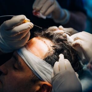 What Happens After 6 Months of Hair Transplant?