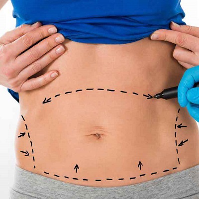 Can Teenagers Go for Liposuction Surgery in Pakistan?