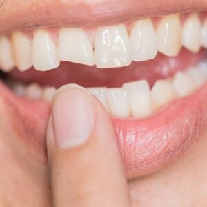 Causes And Prevention of Teeth Fractures