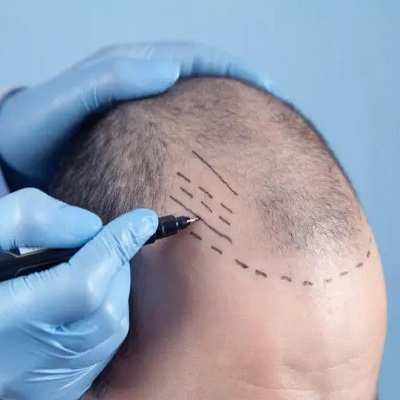 How To Choose the Right Time for A Hair Transplant