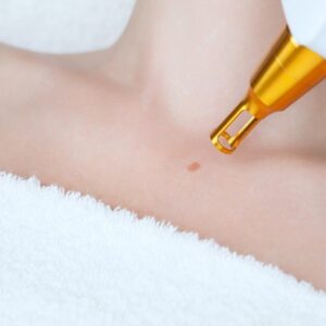 Laser Therapy for Wart Removal: Is It Right for You?