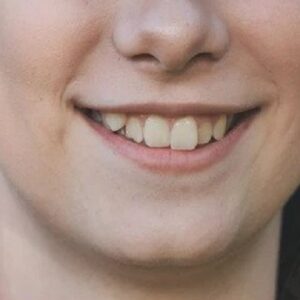 Overlapping Teeth: Tips for Maintaining Oral Hygiene