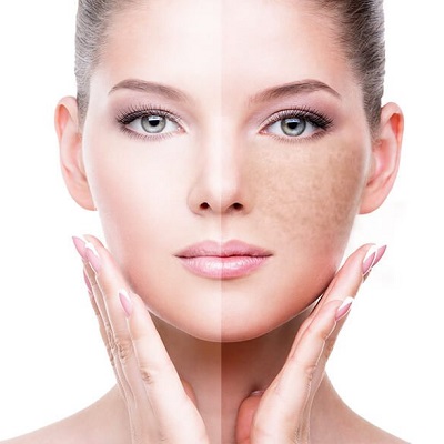 Understanding Hyperpigmentation: Causes and Types