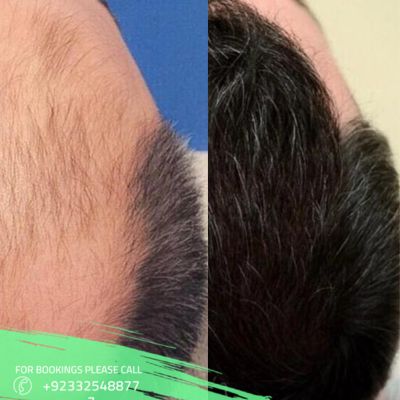 Hair transplant before after results