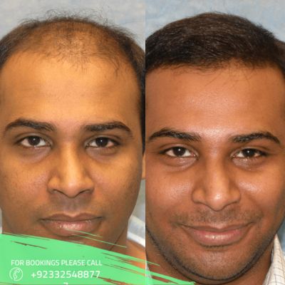 hair transplant cost in Islamabad
